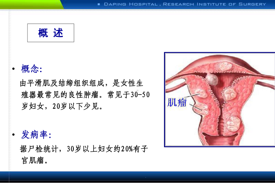 医学子宫肌瘤讲解培训课件.ppt_第2页