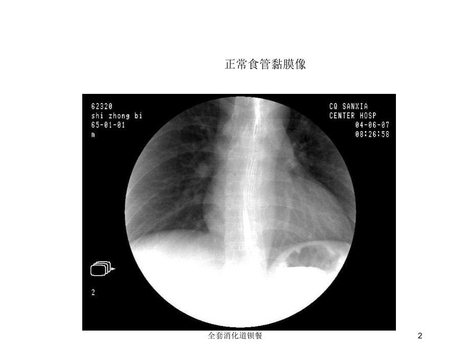 全套消化道钡餐培训课件.ppt_第2页