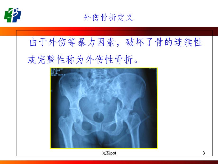 四肢骨折现场急救外固定技术课件.ppt_第3页