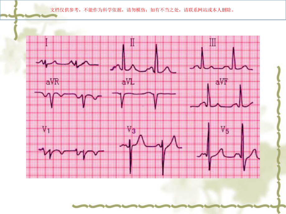 实验诊疗学异常心电图检查培训课件.ppt_第2页