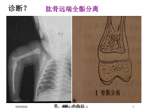 儿童骨骺损伤影像诊疗急课件.ppt