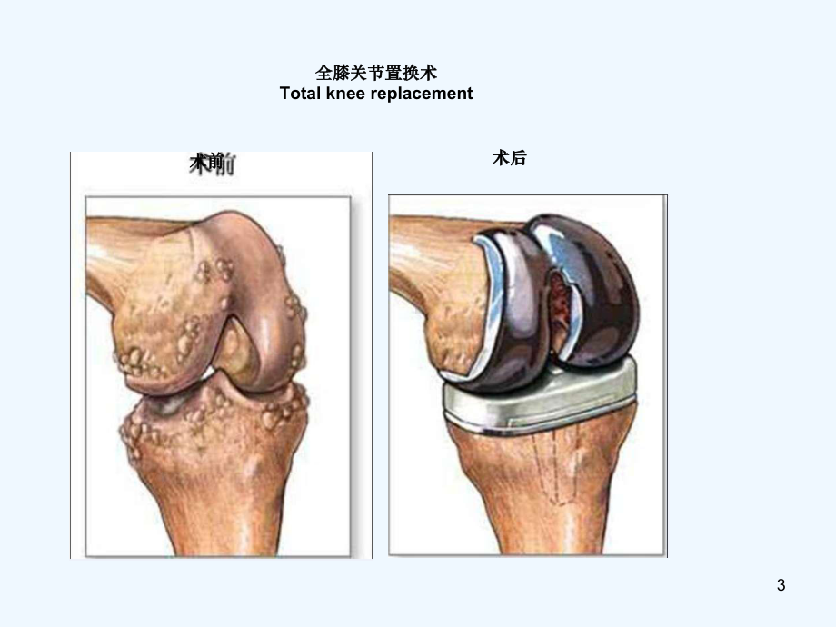 全膝关节置换术后护理课件.ppt_第3页