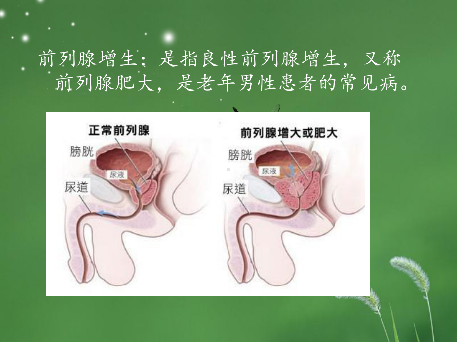 前列腺增生护理查房课件-2.pptx_第3页