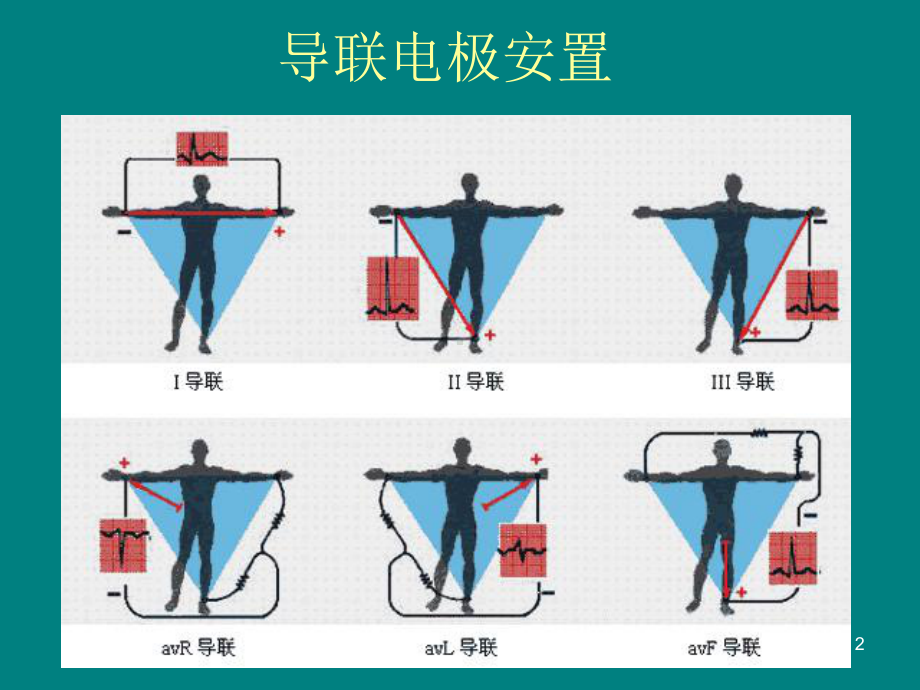 医学课件-冠心病的心电图表现课件.ppt_第2页