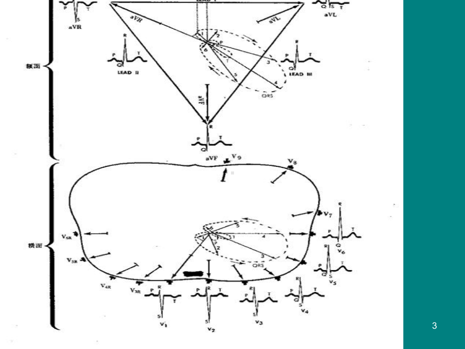 医学课件-冠心病的心电图表现课件.ppt_第3页