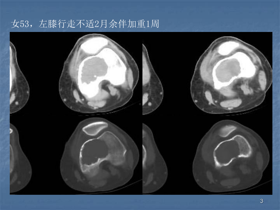 医学课件-骨巨细胞瘤及纤维组织细胞类肿瘤教学课件.ppt_第3页