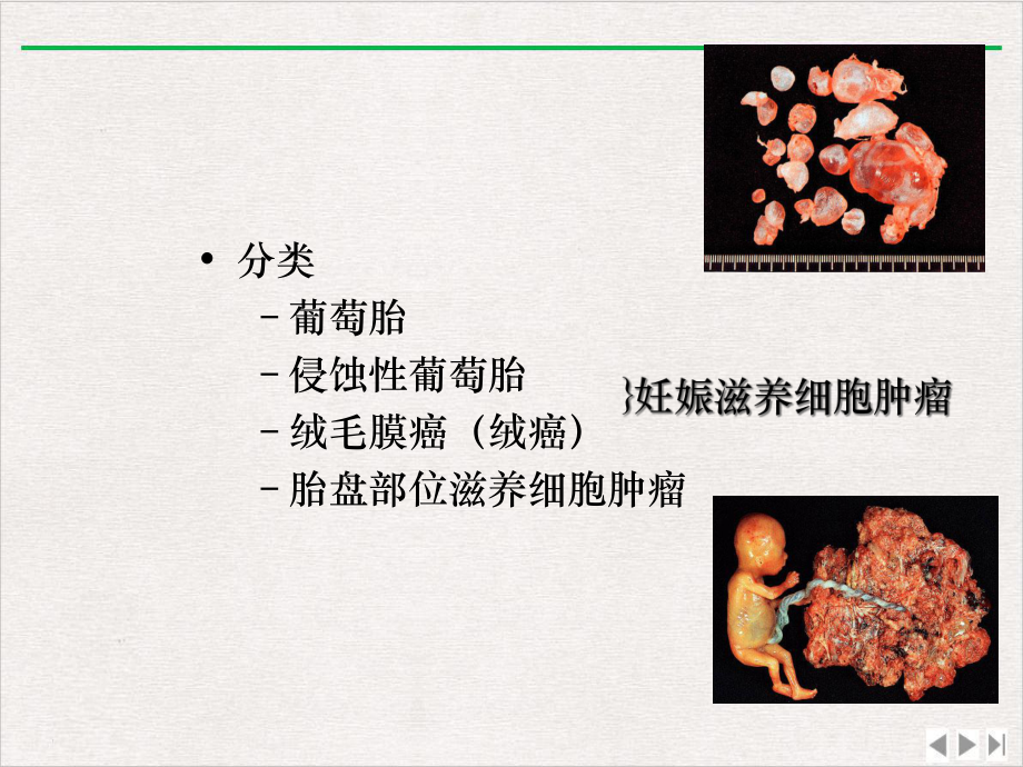 妊娠滋养细胞疾病病理临床表现诊断治疗完美版课件.ppt_第3页