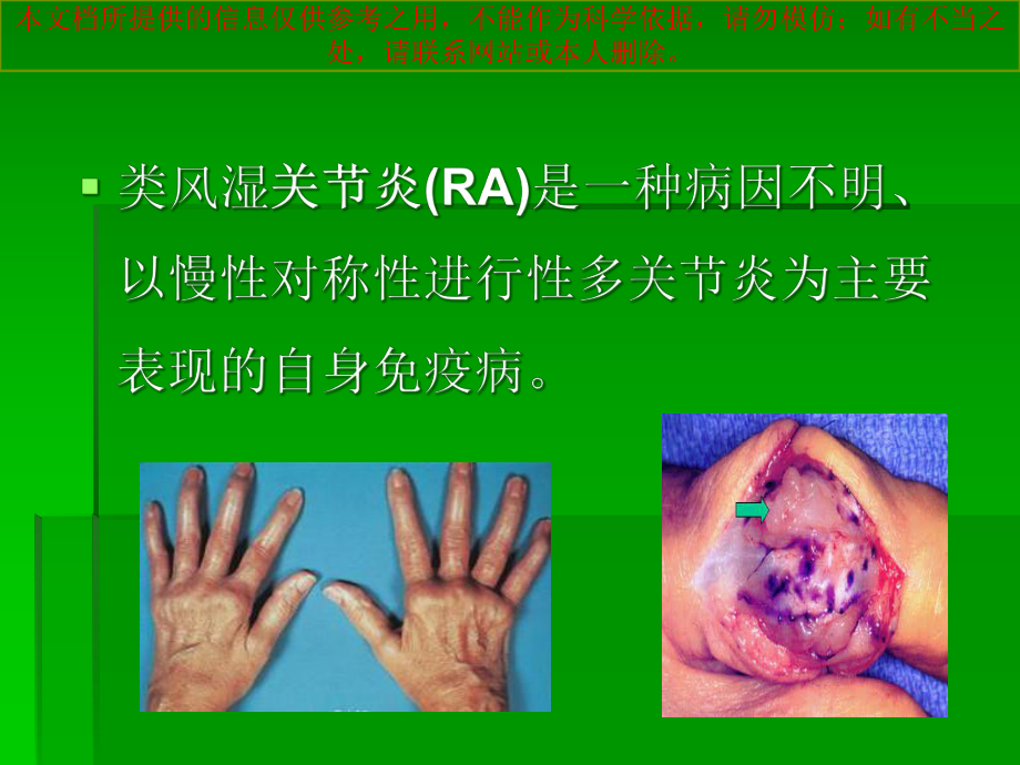 今非昔比类风湿关节炎诊疗和治疗的变迁培训课件.ppt_第3页