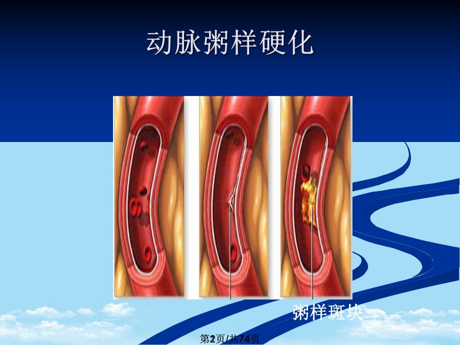 冠心病的护理全面版课件.pptx_第2页