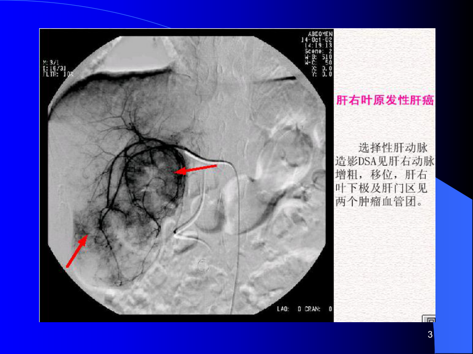 原发性肝癌影像诊断课件.ppt_第3页