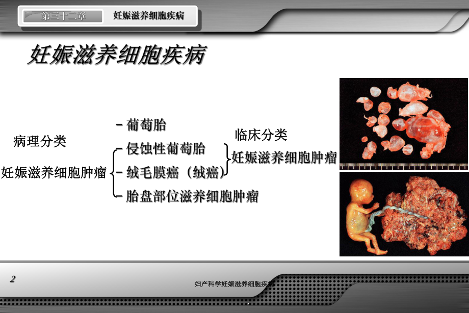 妇产科学妊娠滋养细胞疾病培训课件.ppt_第2页