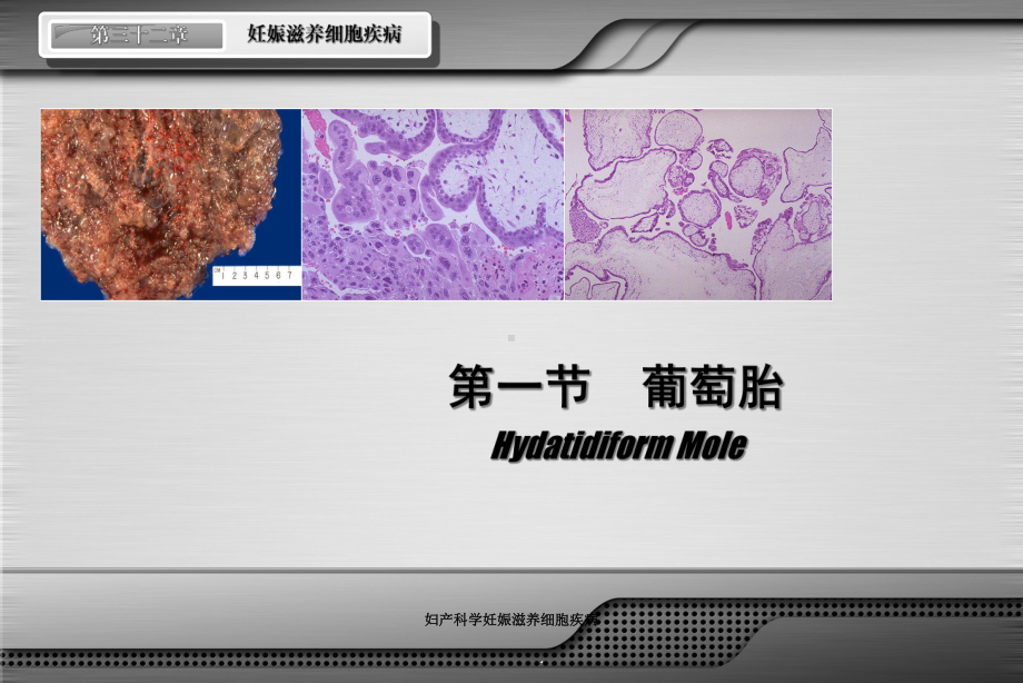 妇产科学妊娠滋养细胞疾病培训课件.ppt_第3页