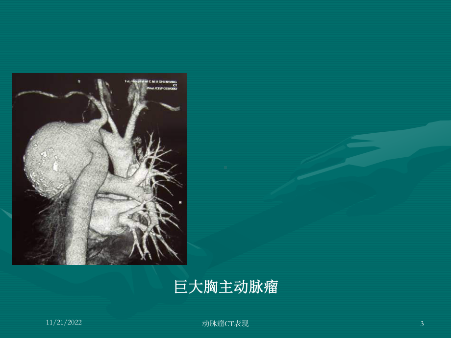 动脉瘤CT表现课件.ppt_第3页