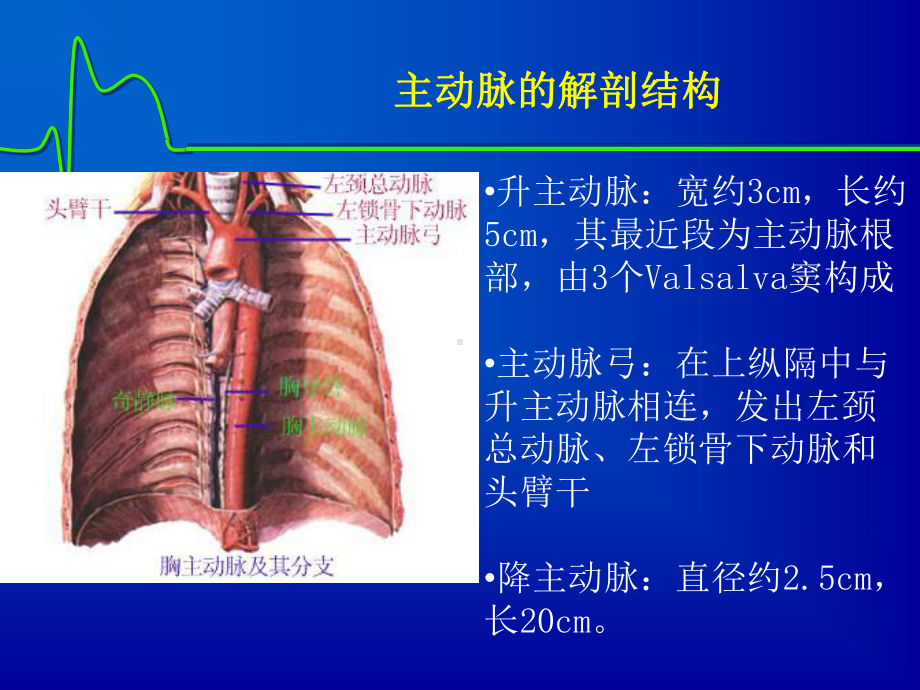 主动脉夹层课件.pptx_第3页