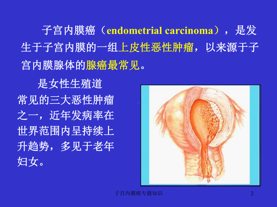 子宫内膜癌专题知识培训课件.ppt_第2页