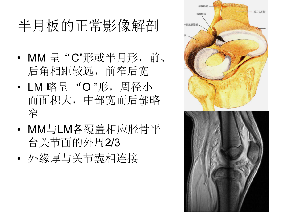 医学膝关节半月板损伤损伤MRI诊断培训课件.ppt_第2页