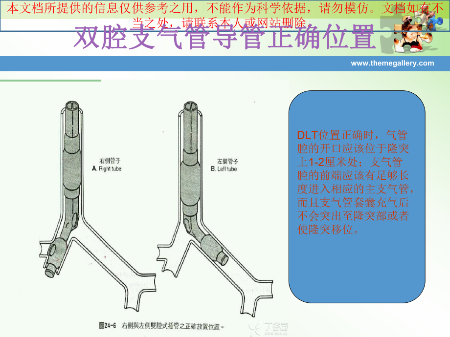 双腔支气管导管定位培训课件.ppt_第3页