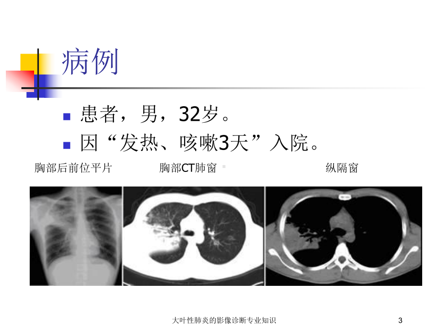 大叶性肺炎的影像诊断专业知识培训课件.ppt_第3页