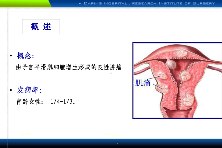 子宫肿瘤讲解课件.ppt_第3页