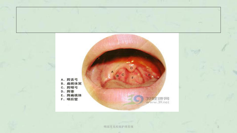 咽部常见疾病护理常规课件.ppt_第2页