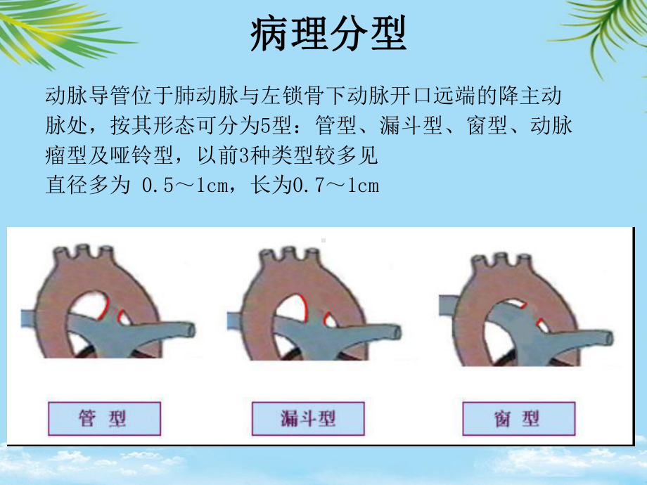 动脉导管未闭封堵术的护理课件.ppt_第3页