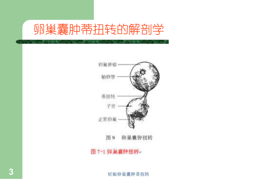 妊娠卵巢囊肿蒂扭转培训课件.ppt_第3页