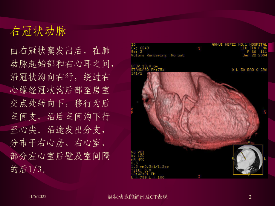 冠状动脉的解剖及CT表现培训课件.ppt_第2页