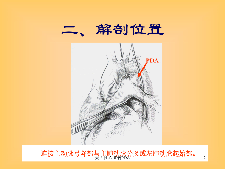 先天性心脏病PDA课件.ppt_第2页