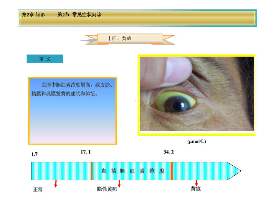 健康评估第2章第2节黄疸课件.ppt_第2页