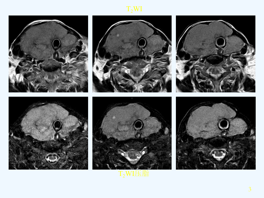 原发性甲状腺淋巴瘤课件.ppt_第3页