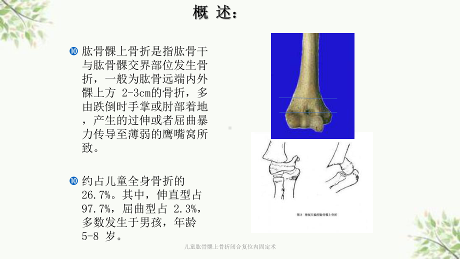 儿童肱骨髁上骨折闭合复位内固定术课件.ppt_第2页