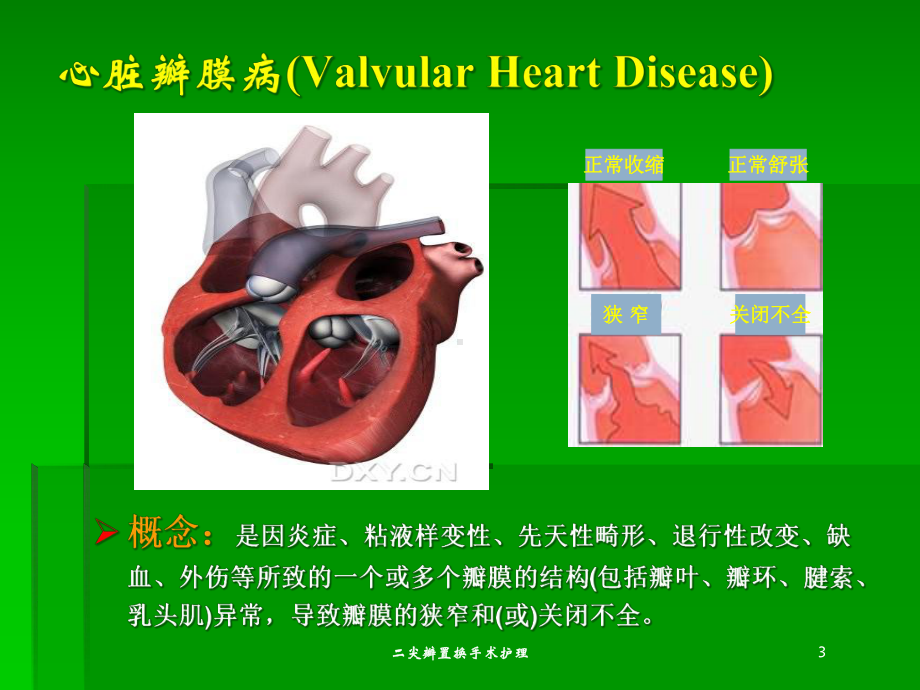 二尖瓣置换手术护理培训课件.ppt_第3页