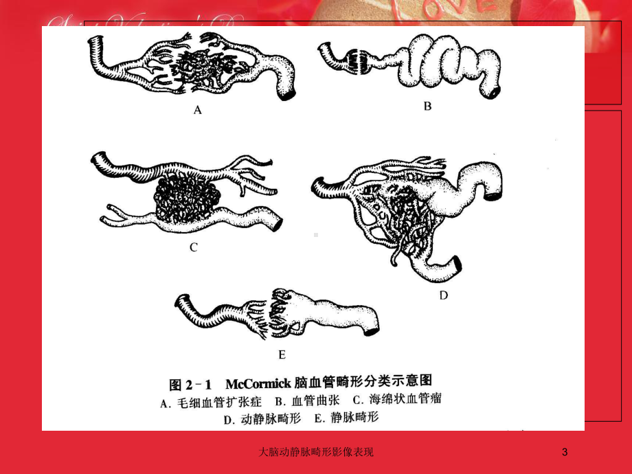 大脑动静脉畸形影像表现培训课件.ppt_第3页