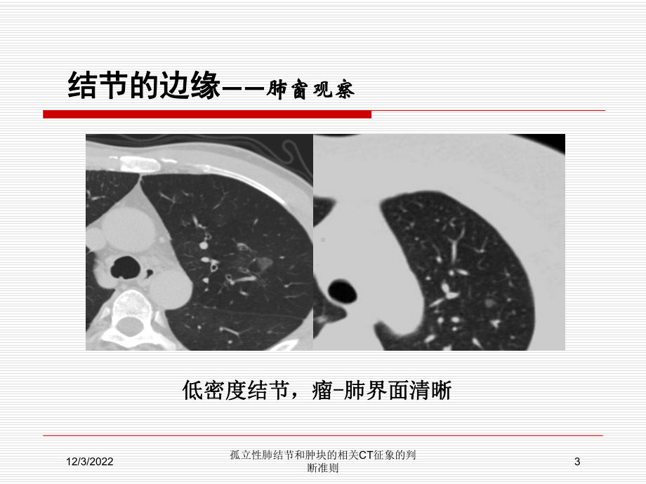 孤立性肺结节和肿块的相关CT征象的判断准则课件.ppt_第3页