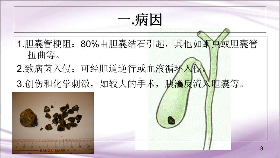 医学课件-胆囊结石护理查房课件.ppt_第3页