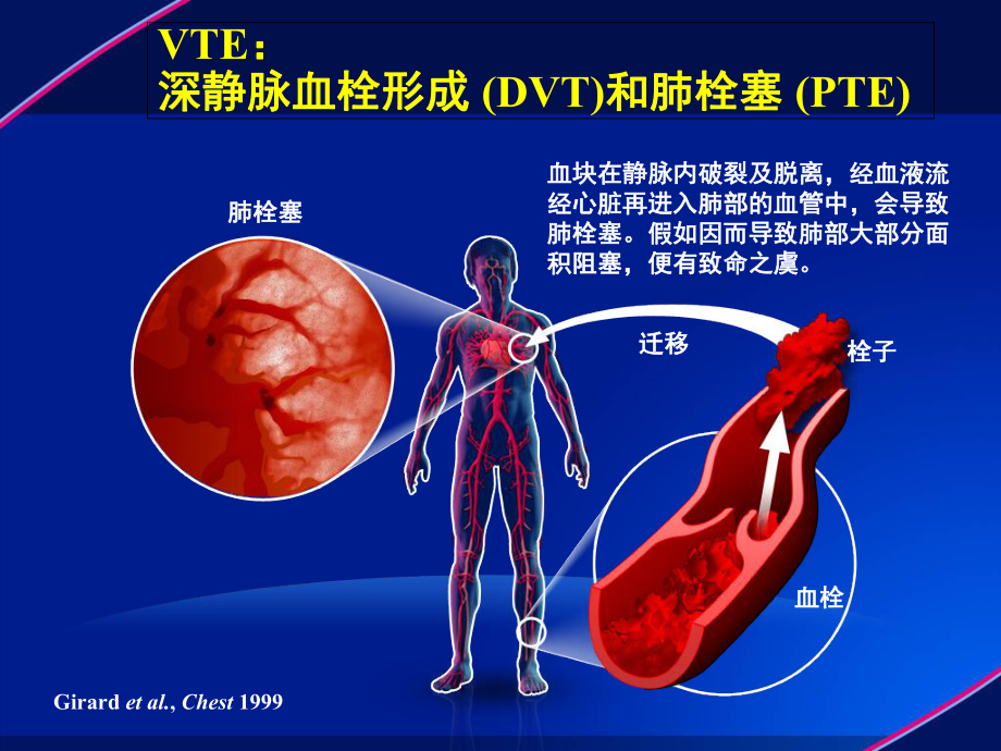 医学静脉血栓VTE防治解读培训课件.ppt_第3页