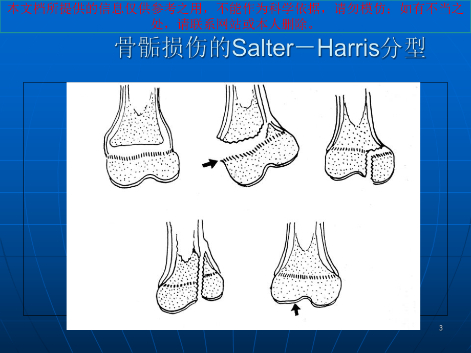 儿童肘关节骨折X线培训课件.ppt_第3页