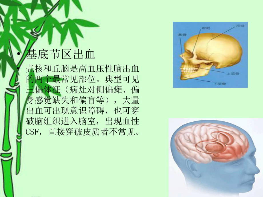 右侧基底节区脑出血讲义课件.ppt_第2页