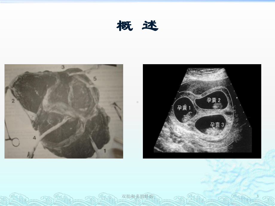 双胎和多胎妊娠培训课件.ppt_第3页