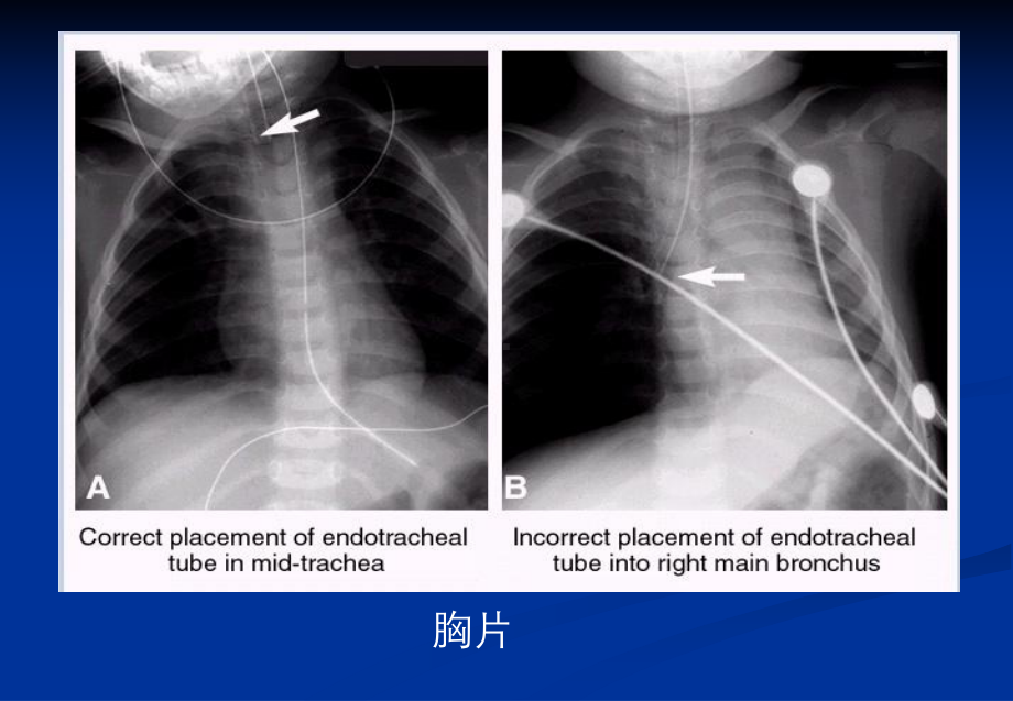 小儿危重症早期识别和处理课件.ppt_第2页