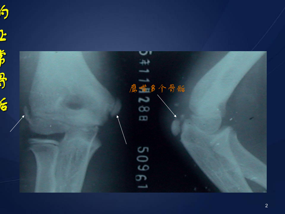 医学课件-肱骨外髁骨折课件.ppt_第2页