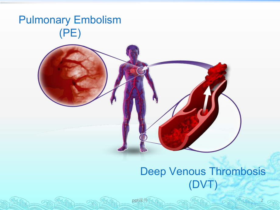 围手术期静脉血栓栓塞(VTE)的防治-课件.ppt_第2页