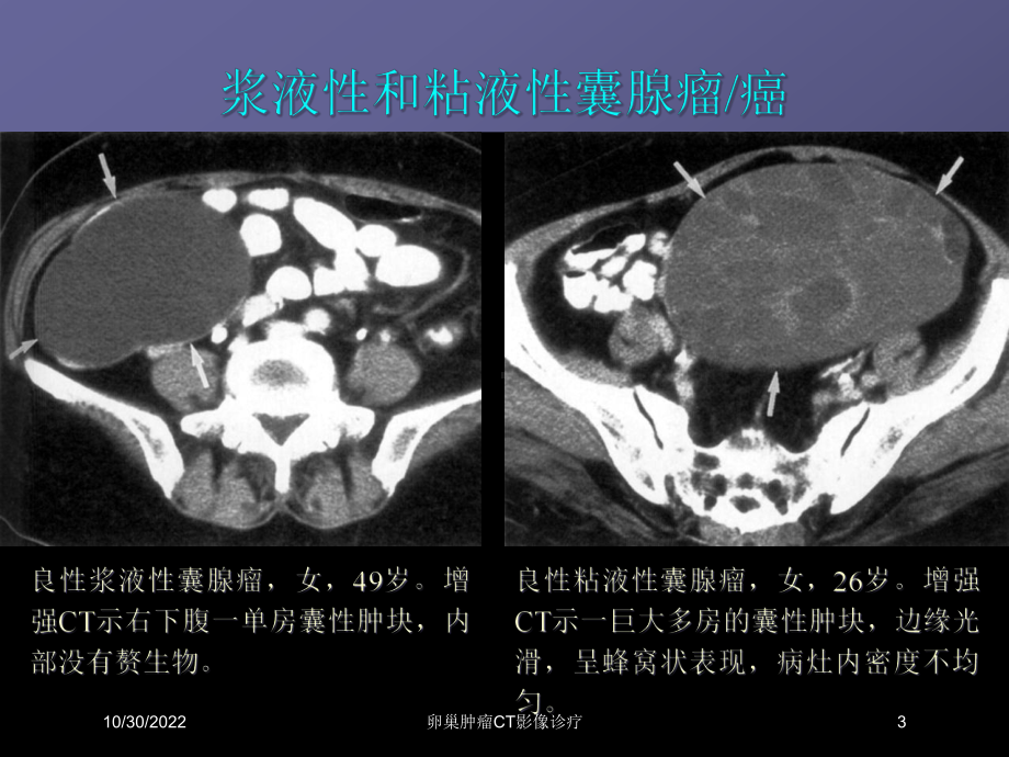 卵巢肿瘤CT影像诊疗课件.ppt_第3页