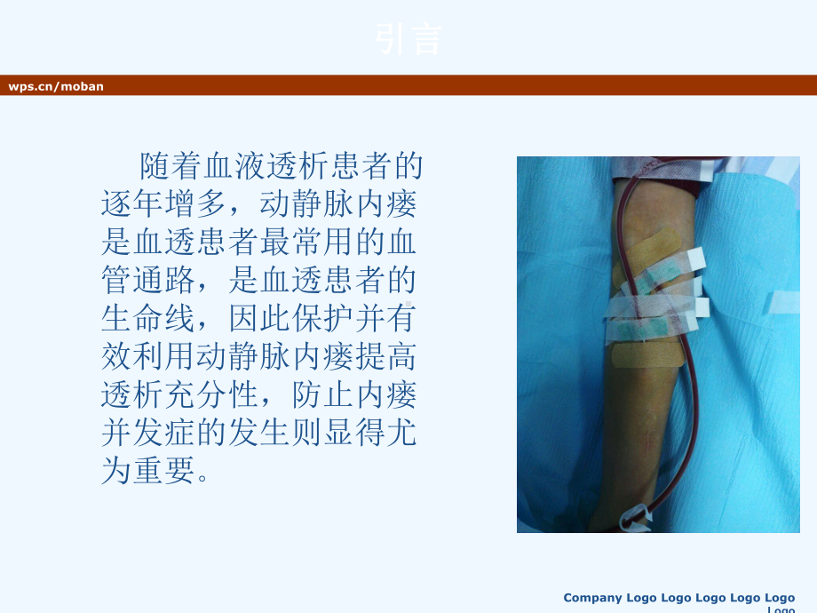 动静脉内瘘的穿刺与护理课件.ppt_第1页