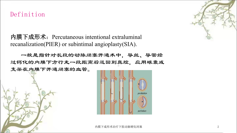 内膜下成形术治疗下肢动脉硬化闭塞课件.ppt_第2页