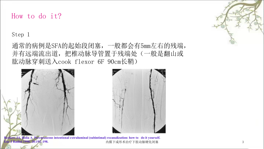 内膜下成形术治疗下肢动脉硬化闭塞课件.ppt_第3页