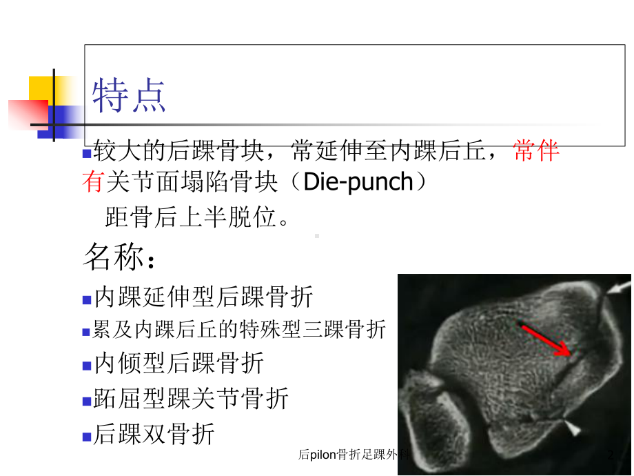 后pilon骨折足踝外科培训课件.ppt_第2页