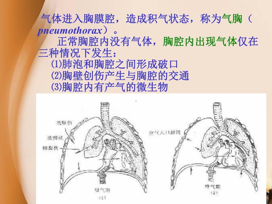 内科胸腔闭式引流术备课讲稿课件.ppt_第3页