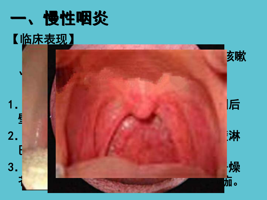 五官科学第六章耳鼻咽喉科常见疾病咽部疾病课件.ppt_第3页