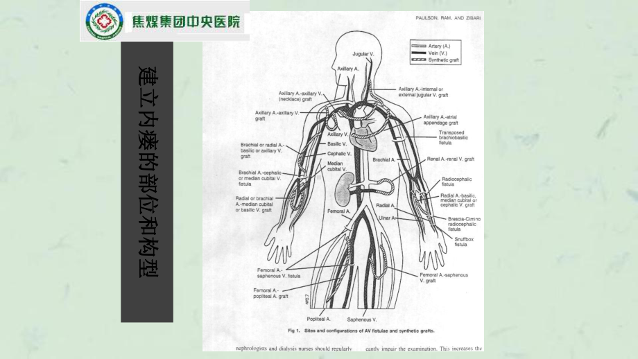 内瘘血管评估使用和维护课件.ppt_第3页